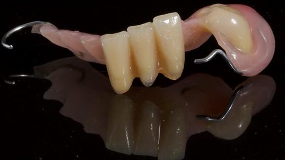 Newsletter 86 Peter the Architect — precision removable partial dentures case study