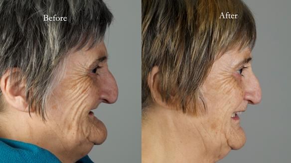 Newsletter 83: Sheila’s Complete Denture Success