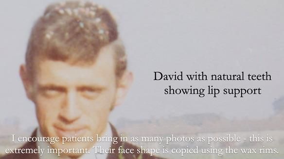 Newsletter 54 case presentation upper complete denture and lower Scandinavian designed hygienic partial denture for David