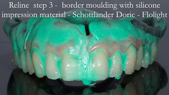 Newsletter 54 case presentation upper complete denture and lower Scandinavian designed hygienic partial denture for David