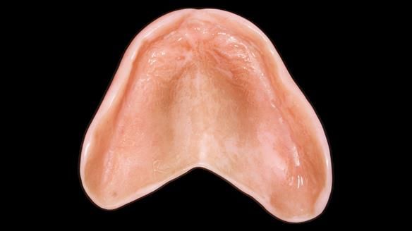 Newsletter 80 - Gordon’s dentures: the one case in 1,000 where my technique failed