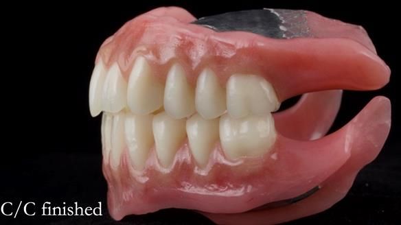 Managing poor implant positioning with complete dentures and Locator attachments - full protocol Newsletter 41