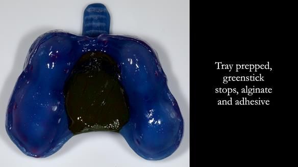 Newsletter 81 - Pam’s Story — how a partial denture changed her life (+ live walkthrough this Thursday)