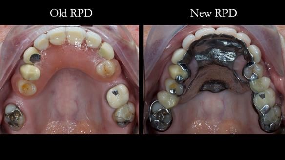 Newsletter 81 - Pam’s Story — how a partial denture changed her life (+ live walkthrough this Thursday)