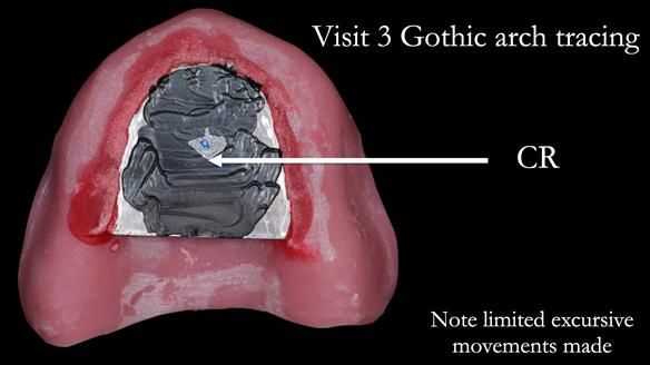 Newsletter 50 Special edition Complete Dentures FULL PROTOCOL