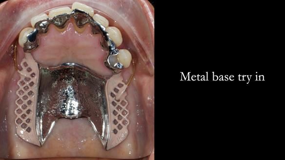 Newsletter 56 showing the making and fitting of a bilateral free end saddle upper removable partial denture (RPD) for patient with pemphigus