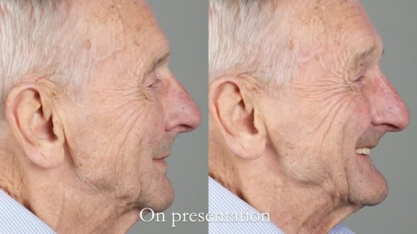 Newsletter 80 - Gordon’s dentures: the one case in 1,000 where my technique failed