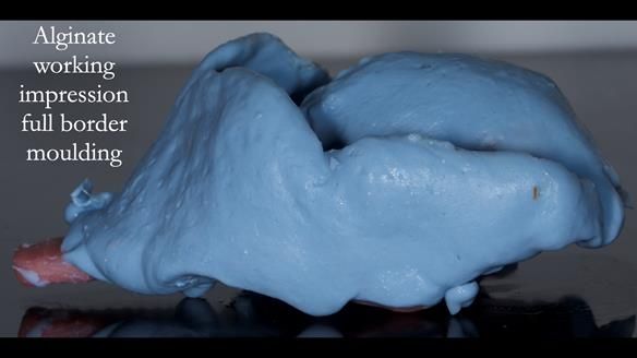 Newsletter 77: Jeremy’s case – immediate complete upper denture