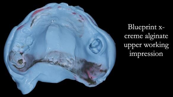 Newsletter 52 Managing Jo’s failing dentition with extractions and Mk 1/Mk 2 complete upper dentures and lower partial dentures FULL PROTOCOL