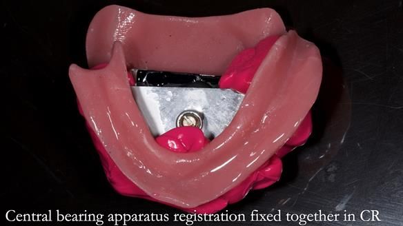 Finlay's Newsletter 59 Ultra hard partial dentures made for Gill