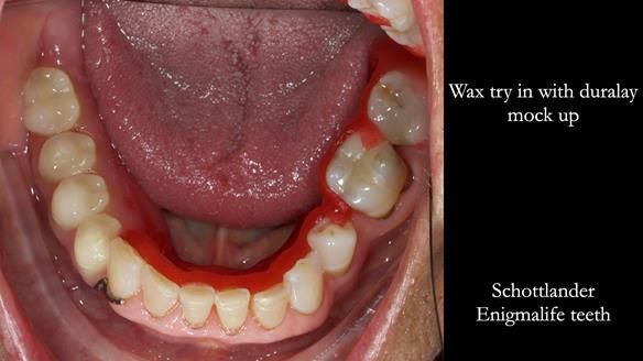Finlay's Newsletter 61 provision of a lower unilateral free end saddle metal based partial denture for Joyce