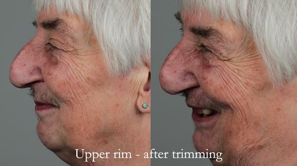 Newsletter 55 Provision of metal based partial dentures for Zephyrine with a repaired cleft lip and palate