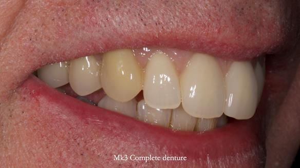 Newsletter 77: Jeremy’s case – immediate complete upper denture