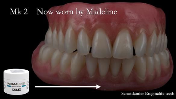 Replacing Madeline’s Complete denture FULL PROTOCOL