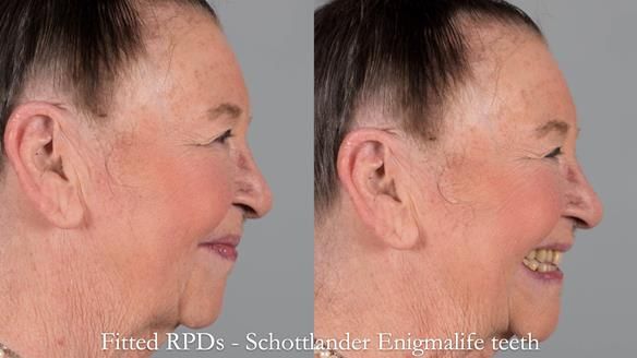 Finlay's Case Study Newsletter 40 - Immediate Mk 1 RPD to Definitive Mk 2 RPD - full protocol