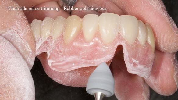 Newsletter 77: Jeremy’s case – immediate complete upper denture