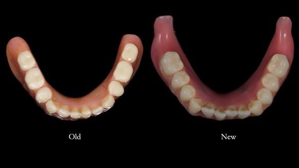 Newsletter 78: What do Clark Gable and a Locator® overdenture have in common?