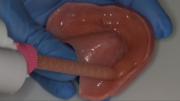 Figure 43 Ufi Gel hard reline material used - placed in the mouth and bordered moulded