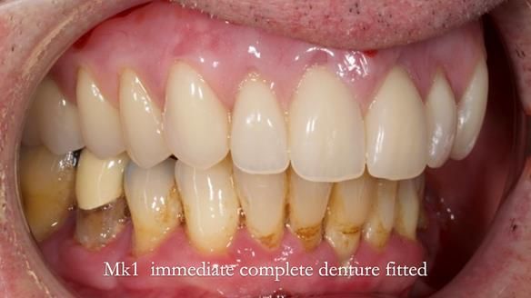 Newsletter 77: Jeremy’s case – immediate complete upper denture