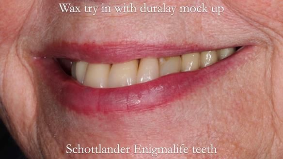 Finlay's Newsletter 59 Ultra hard partial dentures made for Gill