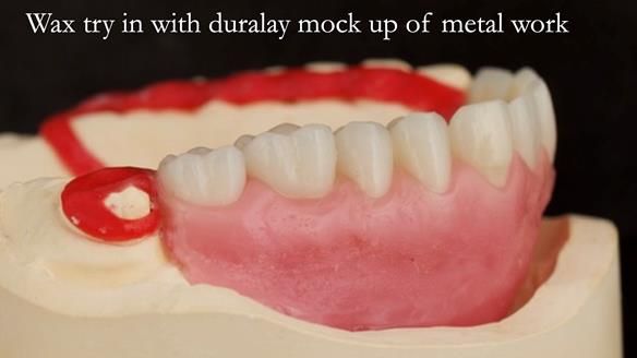 Upper metal base partial denture/occlusal stabilisation splint/obturator - full protocol