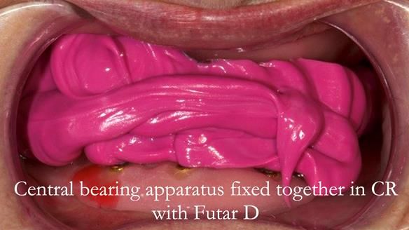 The central bearing apparatus is fixed together with Futar D bite registration material - locking the jaw position to centric relation