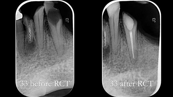 Newsletter 55 Provision of metal based partial dentures for Zephyrine with a repaired cleft lip and palate