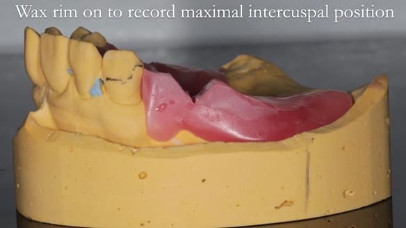 Newsletter 56 showing the making and fitting of a bilateral free end saddle upper removable partial denture (RPD) for patient with pemphigus
