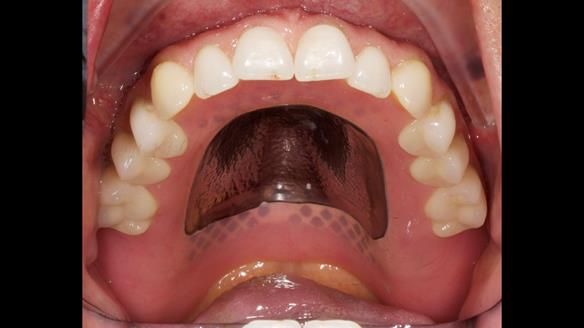 Newsletter 50 Special edition Complete Dentures FULL PROTOCOL