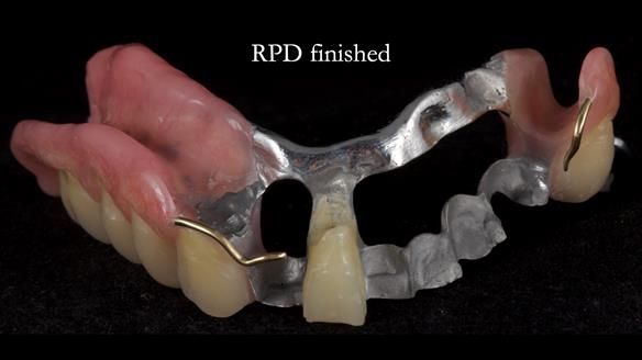 Newsletter 55 Provision of metal based partial dentures for Zephyrine with a repaired cleft lip and palate