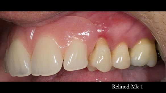 Finlay's Newsletter 63 Case study provision of metal based Scandinavian RPD - functional 10 years on