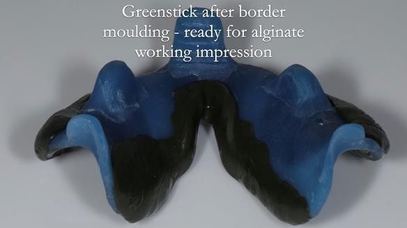 Newsletter 53 showing the making and fitting of ultra life-like dentures for Valena