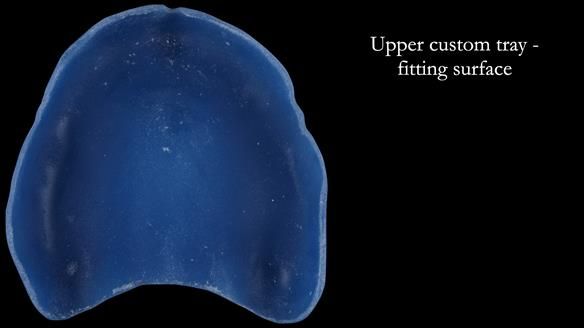 Newsletter 53 showing the making and fitting of ultra life-like dentures for Valena