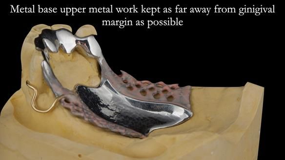 Finlay's Case Study Newsletter 40 - Immediate Mk 1 RPD to Definitive Mk 2 RPD - full protocol