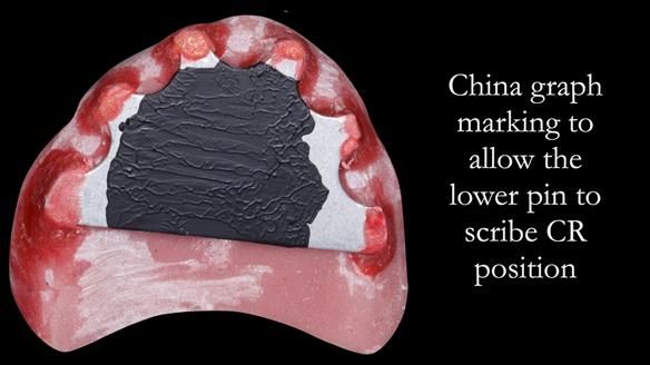 Managing poor implant positioning with complete dentures and Locator attachments - full protocol Newsletter 41