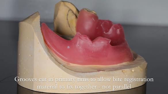 Finlay's Newsletter 59 Ultra hard partial dentures made for Gill