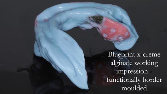 Finlay's Newsletter 59 Ultra hard partial dentures made for Gill