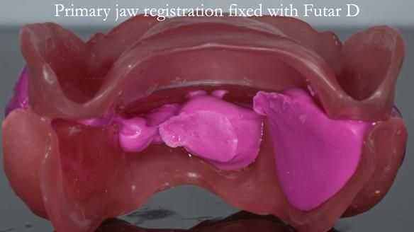 Newsletter 75: Marion’s case - Step-by-step complete denture workflow