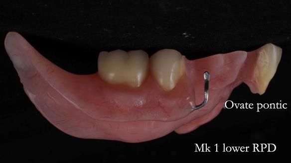Newsletter 54 case presentation upper complete denture and lower Scandinavian designed hygienic partial denture for David