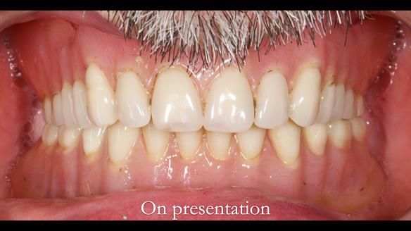 Newsletter 78: What do Clark Gable and a Locator® overdenture have in common?