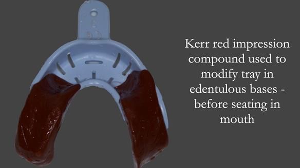 Newsletter 52 Managing Jo’s failing dentition with extractions and Mk 1/Mk 2 complete upper dentures and lower partial dentures FULL PROTOCOL