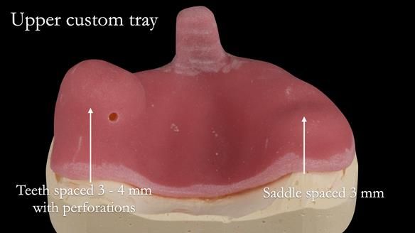 Newsletter 52 Managing Jo’s failing dentition with extractions and Mk 1/Mk 2 complete upper dentures and lower partial dentures FULL PROTOCOL