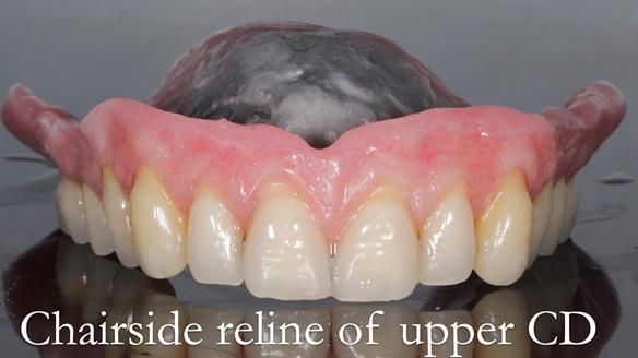 Finlay's Newsletter 62 provision of extractions and metal based complete dentures for Rafique