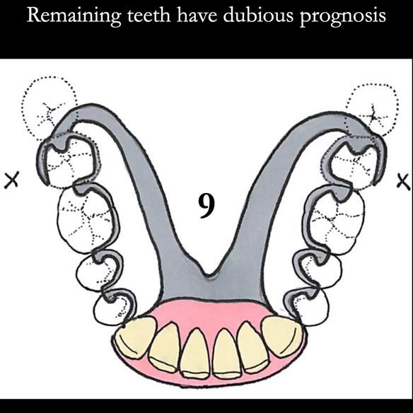 Universal Scandinavian partial denture designs