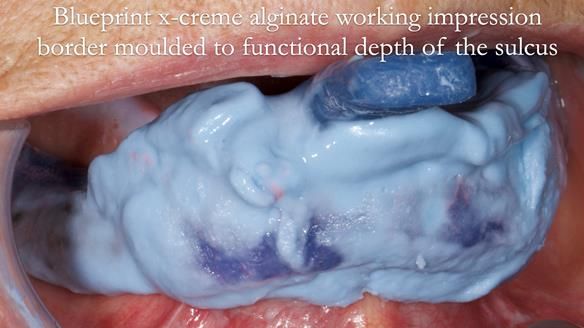 Finlay's Newsletter 61 provision of a lower unilateral free end saddle metal based partial denture for Joyce