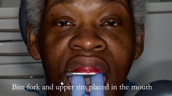 Newsletter 53 showing the making and fitting of ultra life-like dentures for Valena