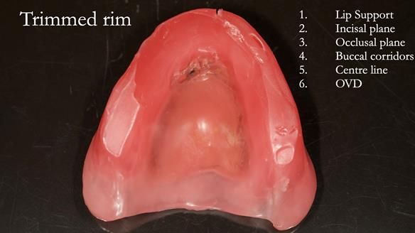 Newsletter 54 case presentation upper complete denture and lower Scandinavian designed hygienic partial denture for David