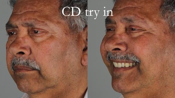 Finlay's Newsletter 62 provision of extractions and metal based complete dentures for Rafique