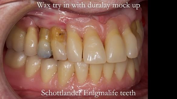Finlay's Newsletter 59 Ultra hard partial dentures made for Gill