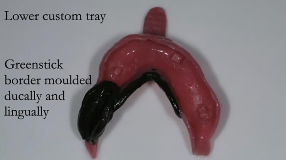 Newsletter 54 case presentation upper complete denture and lower Scandinavian designed hygienic partial denture for David